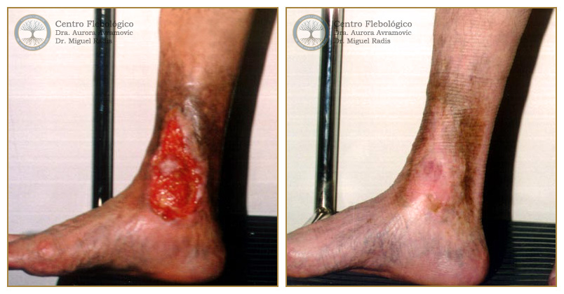 Úlcera postrombótica con angiodermitis ocre