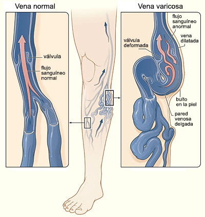 vena varicosa